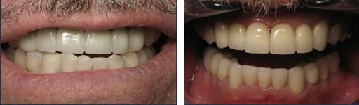 A recent dental crown implant job in the Huron, SD area