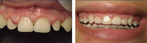 A recent cosmetic dentist job in the Huron, SD area